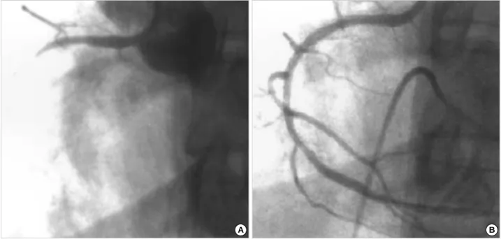 Fig. 2. Coronary angiography of the right coronary artery on left anterior oblique view