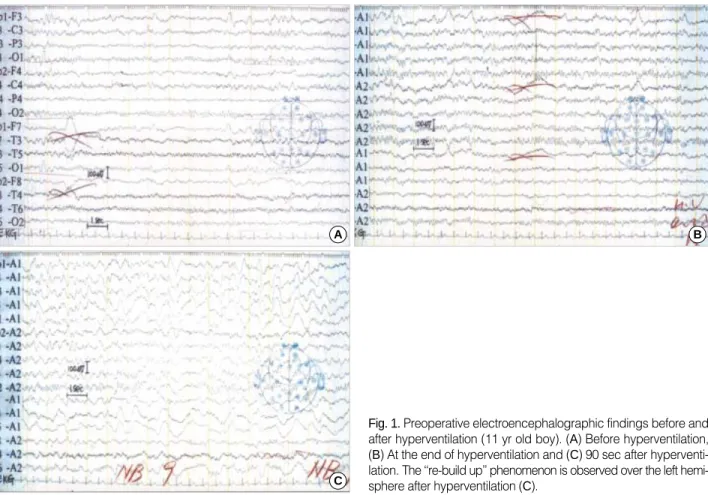 Fig. 1. Preoperative electroencephalographic findings before and after hyperventilation (11 yr old boy)