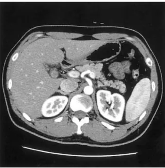 Fig. 1. Endoscopic retrograde cholangiopancreatography (ERCP) reveals the common bile duct stricture