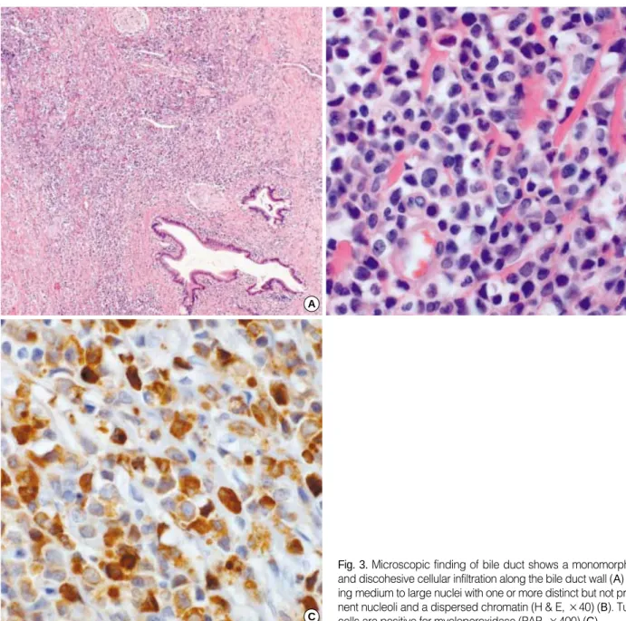 Fig. 3. Microscopic finding of bile duct shows a monomorphous and discohesive cellular infiltration along the bile duct wall (A)  hav-ing medium to large nuclei with one or more distinct but not  promi-nent nucleoli and a dispersed chromatin (H &amp; E,  ×