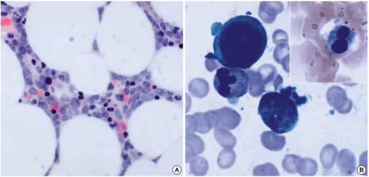 Fig. 4. Bone marrow findings. Monomorphic myeloblasts in trephine biopsy (H &amp; E,  ×400) ( A)