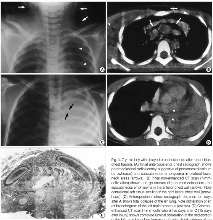 Fig. 1. 7-yr-old boy with delayed bronchostenosis after recent blunt chest trauma. (A) Initial anteroposterior chest radiograph shows paramediastinal radiolucency suggestive of pneumomediastinum (arrowheads) and subcutaneous emphysema in bilateral lower ne