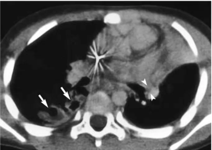 Fig. 2. 2-yr-old boy with delayed bronchostenosis after recent blunt chest trauma. Contrast-enhanced chest CT scan  (3-mm-collima-tion) obtained 15 days after blunt chest trauma shows left upper lobe atelectasis