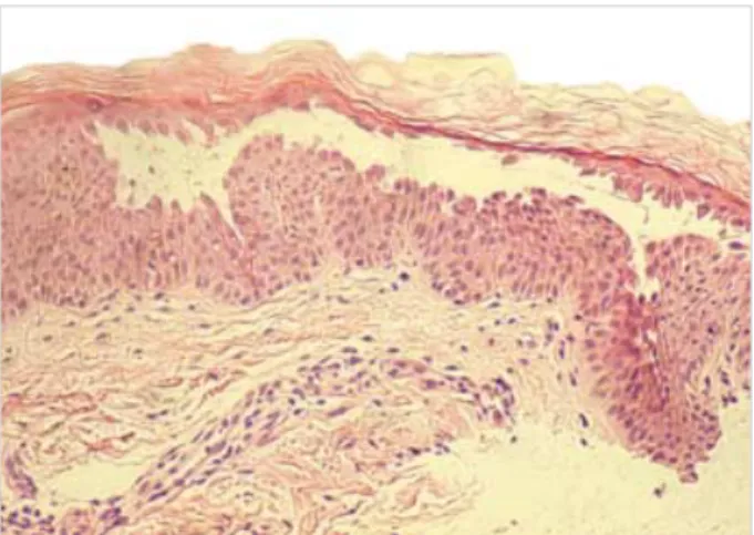 Fig. 2. Skin biopsy shows acantholysis at the suprabasal layer, as well as at the upper layers of epidermis (H&amp;E, ×400).