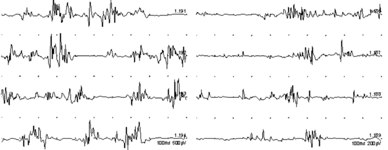 Fig. 1. The  result  of  repetitive  nerve  stimulation  testing.  There  was  no  abnormal  decremental  responses  at  low  rate  stimulation  (2,3,5  Hz)  in  the  trapezius  muscles