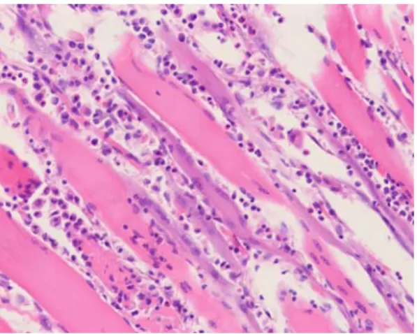 Fig. 3. The  vastus  lateralis  biopsy  shows  a  diffuse  inflammatory  cell  infiltration,  and  it  is  mainly  lymphocytes,  plasma  cells  and  eosinophils