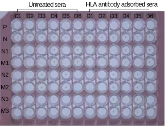 Fig. 3. Granulocyte antibody test using the mixed passive hemag- hemag-glutination assay (MPHA)