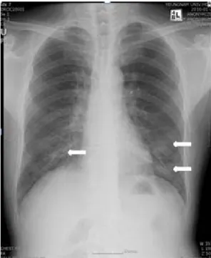 Fig.  3.  Initial  chest  X-ray  of  the  subject.