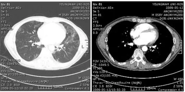 Fig. 5. Follow-up  chest  CT  of  the  subject.  The  progression  of  multifocal  ground  glass  opacities  with  interstitial  thickening  in  both  lungs  is  noted.