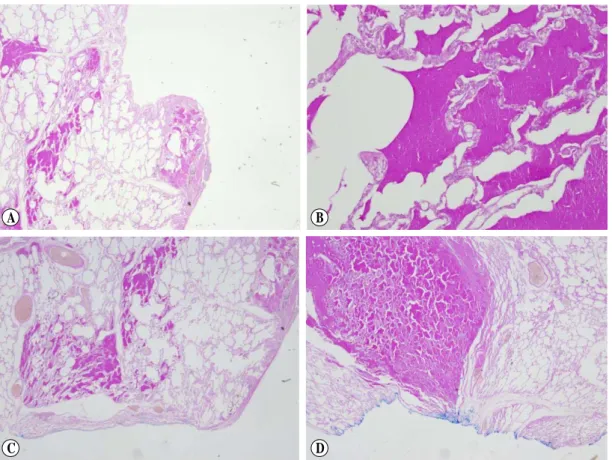 Fig. 7. The  pathology  findings  were  large  groups  of  alveoli  with  excessive  amounts  of  surfactant  and  a  complex  mixture  of  protein  and  lipid(fat)  molecules  (A),  positive  PAS  staining  (B)  and  negative  GMS  staining  (C),  (D)