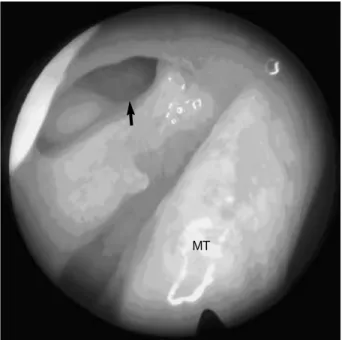 Table 1. Surgical results in 46 cases of primary endoscopic dacry- dacry-ocystorhinostomy