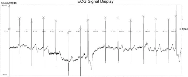 Fig. 3. Example of ECG after the R-wave detection for narrow patch type electrode