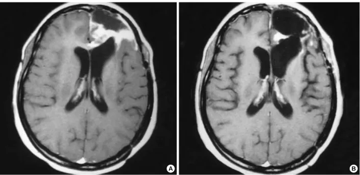 Fig. 1. Pre-chemotherapy MR image (A) and MR image after three courses of temozolomide (B) of a patient with a grade 4 glioma, consis- consis-tent with a partial response.
