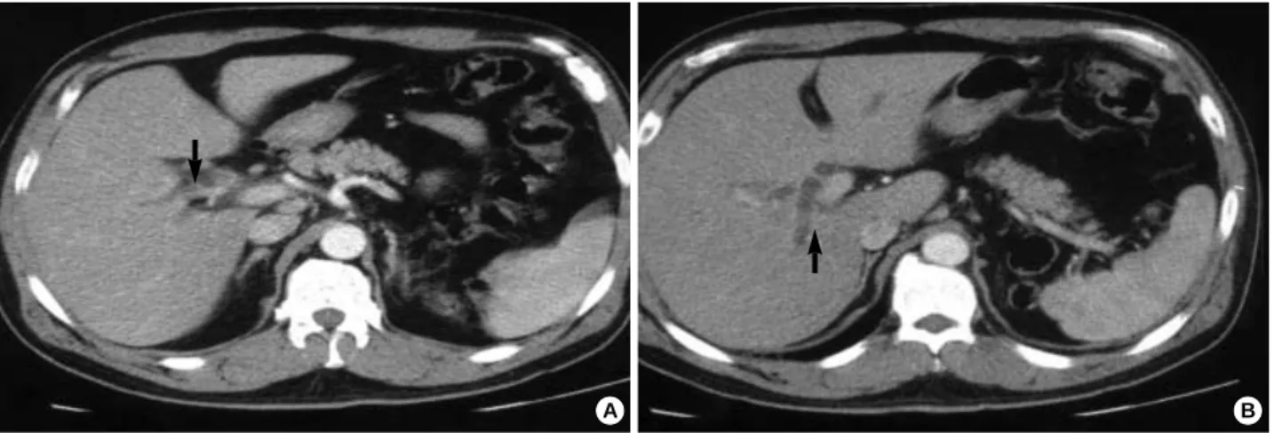 Fig. 2. Magnetic resonance cholangiography showing dilatation of both intrahepatic duct and right posterior duct