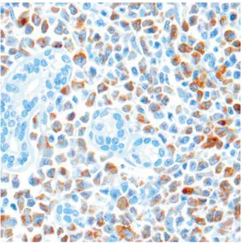 Fig. 4. Immunohistochemical stain for myeloperoxidase (MPO) reveals positive granular cytoplasmic staining of most of the myeloid cells except for the most immature precursors, and the epithelial cells of the bile ducts (×400)
