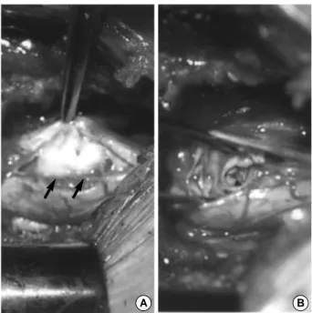 Fig. 2. Contrast-enhanced axial image showing peripheral en- en-hancement of the lesion (arrow).