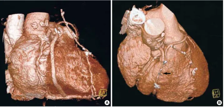 Fig. 1. Serial images of 3-D CT at immediate and 6-months postoperatively in 65-yr old man