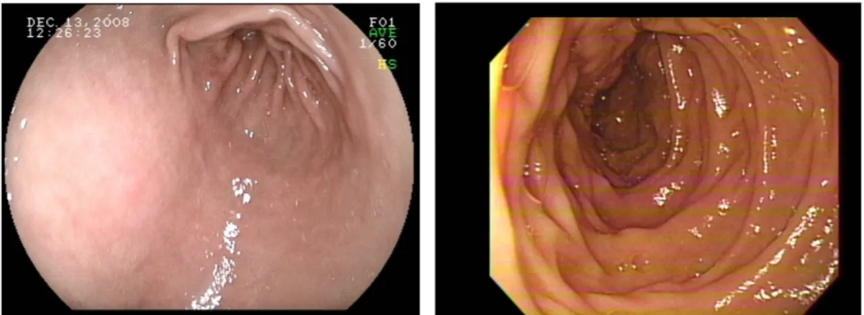 Fig. 1. Gastroscopic  findings.  The  findings  do  not  show  the  specific  evidence  of  bleeding.