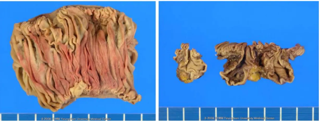 Fig. 3. The  specimen  from  the  segmental  jejunal  resection  shows  that  the  diverticulum  was  the  source  of  hemorrhage.