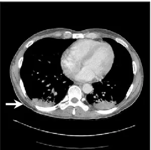 Fig. 1. Chest  PA:  Note  the  nodular  consolidations  (arrow)  at  both  lower  lung  fields.