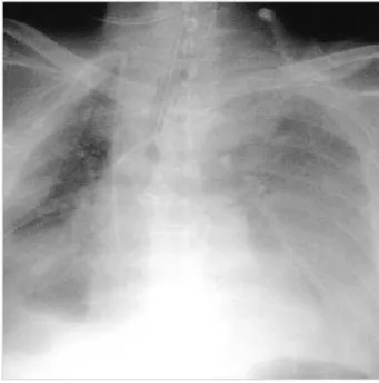 Fig. 2. Computed tomography of the abdomen demonstrating a solid mass in the tail of the pancreas with attachment to the spleen.