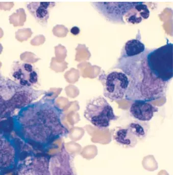 Fig. 4. Smear of pleural effusion sediment showing several early granulocytes with morphologic features similar to the cells in the bone marrow (Wright-Giemsa stain, ×1,000)