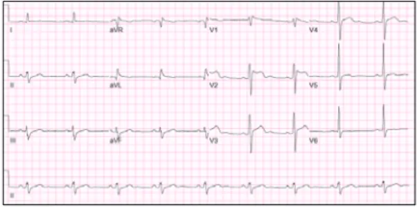 Fig. 1. The  resting  12‐lead  ECG  findings  show  RBBB  with  ST‐segment  elevation  in  the  right  precordial  leads.