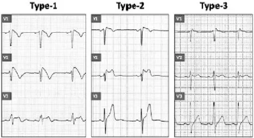 Table  1.  Diagnostic  criteria  of  the  Brugada  syndrome