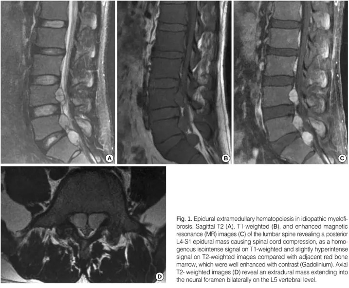 Fig. 1. Epidural extramedullary hematopoiesis in idiopathic myelofi- myelofi-brosis. Sagittal T2 (A), T1-weighted (B), and enhanced magnetic resonance (MR) images (C) of the lumbar spine revealing a posterior L4-S1 epidural mass causing spinal cord compres