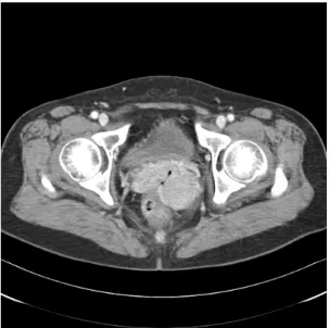 Fig. 2. About  4  cm  sized  enhancing  solid  mass  lesion  was  seen  in  exocervix  but  it  was  not  certain  whether  it  was  originated  in  cervix  or  vaginal  wall.