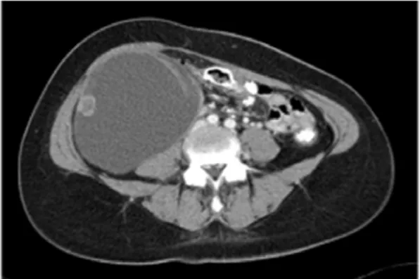 Fig. 1. Computed  tomography  shows  a  retroperitoneal  multilocular  cyst  with  thick  irregular  wall  and  septum