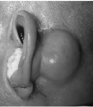 Fig. 1. A  preoperative  photograph  shows  an  approximate  3  ×  3  cm  sized,  round  shaped  mass  at  the  left  retroauricular  area.