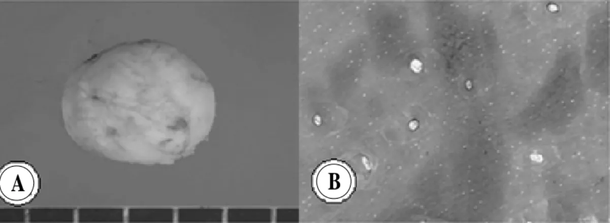 Fig. 3. The  photographs  of  surgical  specimen  (A)  and  histopathologic  finding  (B)