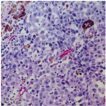 Fig. 5. Photomicrograph of the tumor showing junctional activities of atypical melanocytes around base of the tumor (H&amp;E, ×100).