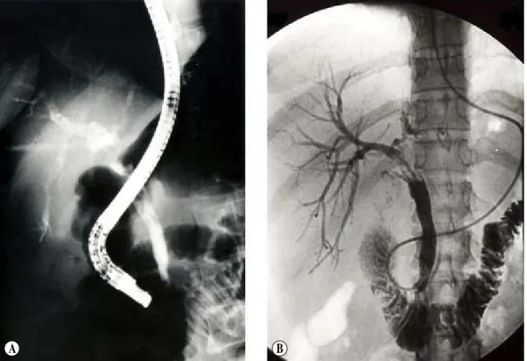 Fig. 2. A;  Endoscopic  retrograde  cholangiogram.  multiple  filling  defects  in  common  hepatic  duct  and  dilatation  of  right  intrahepatic  duct  is  seen
