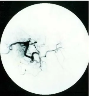 Fig. 4. Gross  pathology.  2.5×1.7cm  sized  mass  in  segment  2  and  9.5×6.0cm  sized  intraductal  mass  in  segment  3  are  seen