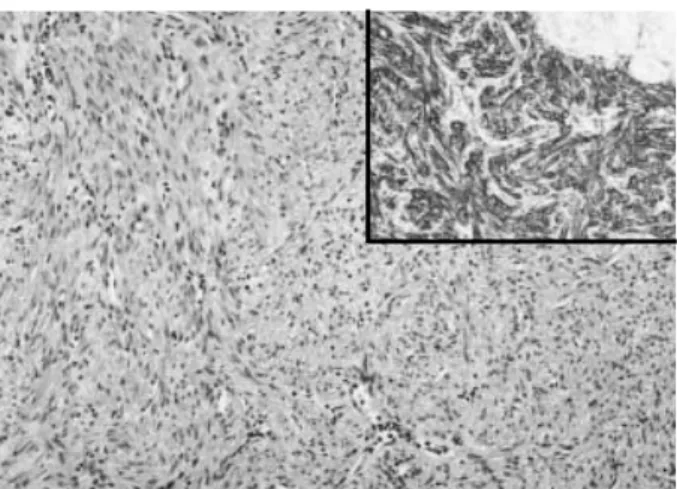 Fig. 3. Grossly solid portion displays spindle cells in the fibrillar background (H&amp;E, ×100)