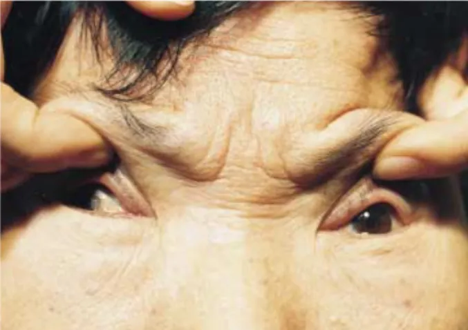 Fig. 4. Postoperative photograph by one year follow-up shows lateral deviation in the right eye, centrally fixed pupil in the left eye, and both isocoric and reactive pupils
