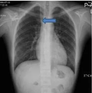 Fig. 2. Preoperative  chest  X-ray.  Normal  finding  in  preoperative  chest  X-ray.