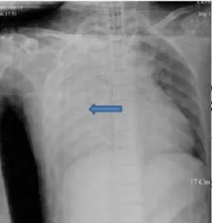 Fig. 3. Pleural  effusion.  Chest  radiograph  shows  large  amount  of  right  pleural  effusion  with  diffuse  increased  right  lung  shadow(arrow).