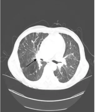 Fig. 3. PFT  shows  severe  obstructive  ventilatory  defect  and  no  significant  bronchodilator  response.