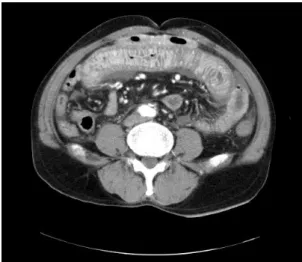 Fig. 1. Abdominal  CT  shows  marked  wall  thickening  of  small  and  large  bowel.