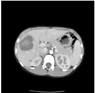 Fig. 3. Follow  up  enhanced-CT  scan  after  8  days  shows  no  internal  change  previously  noted  multiple  cystic  lesions  in  the  liver
