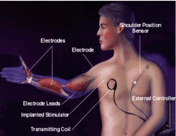 Fig. 1. Implantable  Functional  Electrical  Stimulation  system.