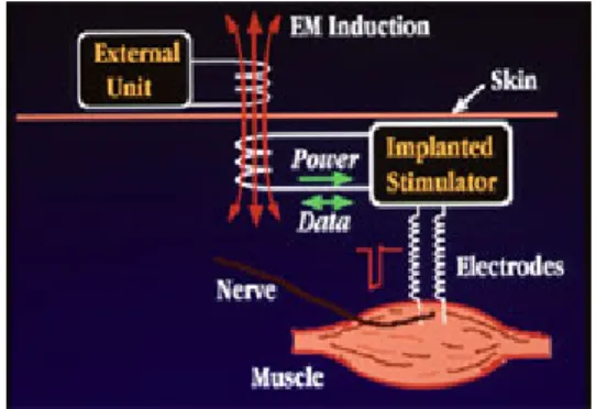 Fig. 4B. Confuguration  of  implantable  Functional  Electrical  Stimulation.