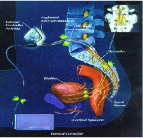 Fig. 6. VACARE  bladder  stimulator. 위해서는  수  차례  간헐적인  자극이  반복  되어야  한다. 이러한  천수  운동신경근  자극법으로  방광의 배출  기능은  회복  될  수  있으나,  방광  과반사에  의한  저장  기능  이상은  회복  되지  않는다