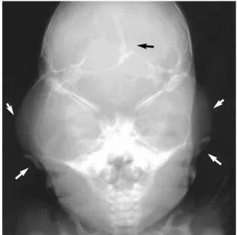 Fig. 2. Skull AP view showed typical ‘‘cloverleaf’’ skull with severe temporal bulging (white short arrows), lacunar skull (black arrow), poorly developed maxillary bone, and significantly low-set ears with angulated posteriorly (white long arrows).