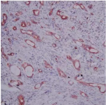 Fig. 3. Higher magnification shows the strands of cells with duct- duct-like structures.; the cytoplasm is scanty (H&amp;E stain, ×200).