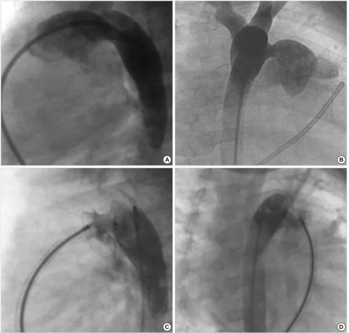 Fig. 3. Aortogram in lateral (A) and right anterior oblique view (B) displaying a large patent ductus arteriosus, 5 mm in diameter