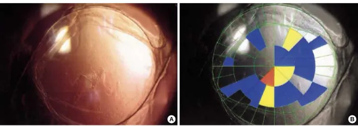 Fig. 1. The severity grades of posterior capsular opacification with the POCOman software